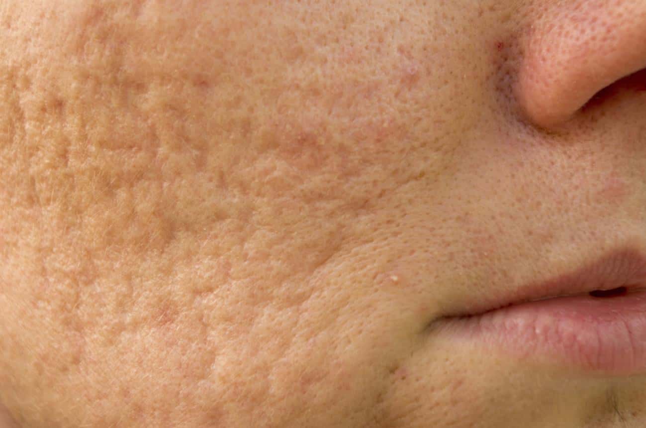 Carboxytherapy - Maslak 3 H tmrlxhnGbsIUaFnMH3ky hXQZ3sMSNRT4r0vMaoMr2 eAGUF8mPaa6U5RA859rzDEzV2 tWAibqmQDySVasJU7gi9K2Z2PkNm3c SNmZn6Gq9qYs47WNgFNZs acne scars treatment Istanbul